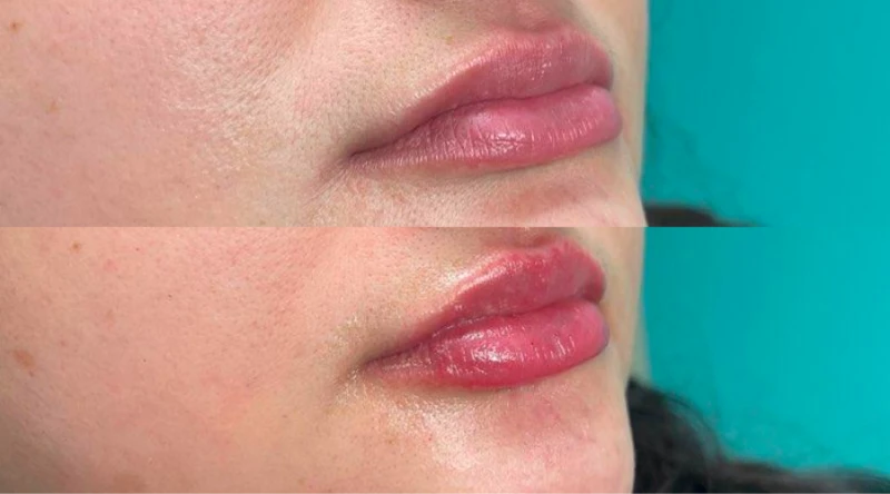 Nashville dermal fillers